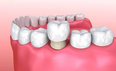 dental crown in alpharetta