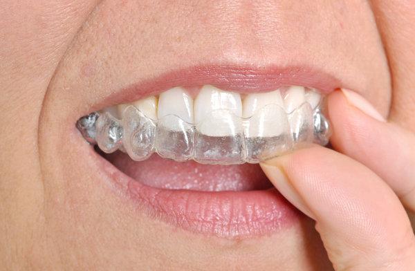clear aligner | 30022 Dentist Alpharetta