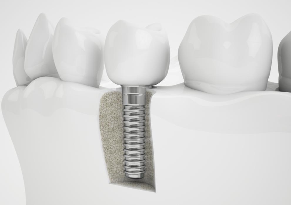 Dental Implants Alpharetta GA