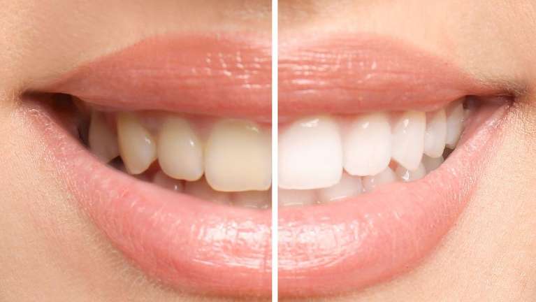 An Picture of teeth before and after whitening in Alpharetta Creek Restorative Dentistry