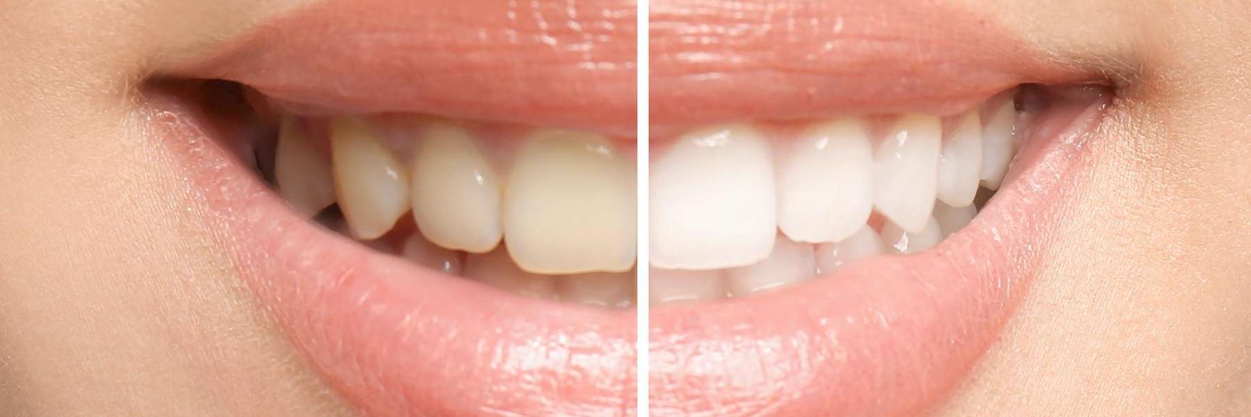 A comparison photo of before and after image for teeth Whitening from Alpharetta Dentists
