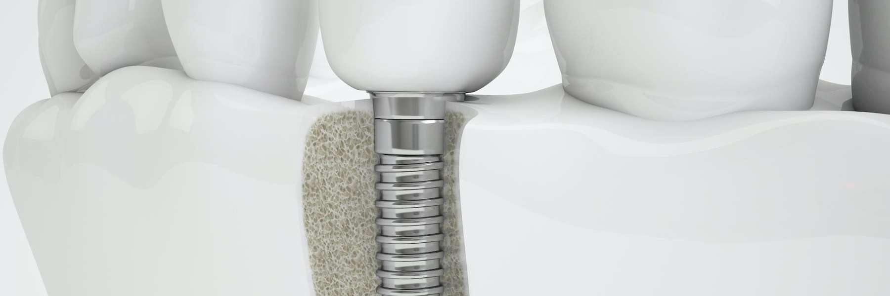 dental implant