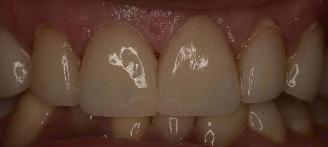 Broken Veneers | Alpharetta Creek Restorative Dentistry