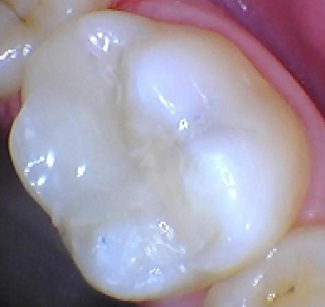 Broken Filling Replaced | Alpharetta Creek Restorative Dentistry