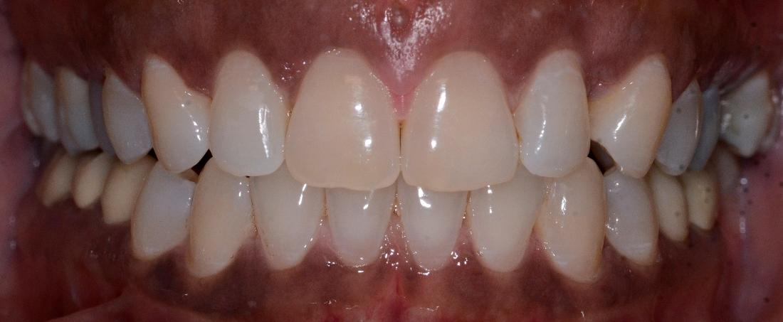 front teeth realigned and space fixed after clear aligners