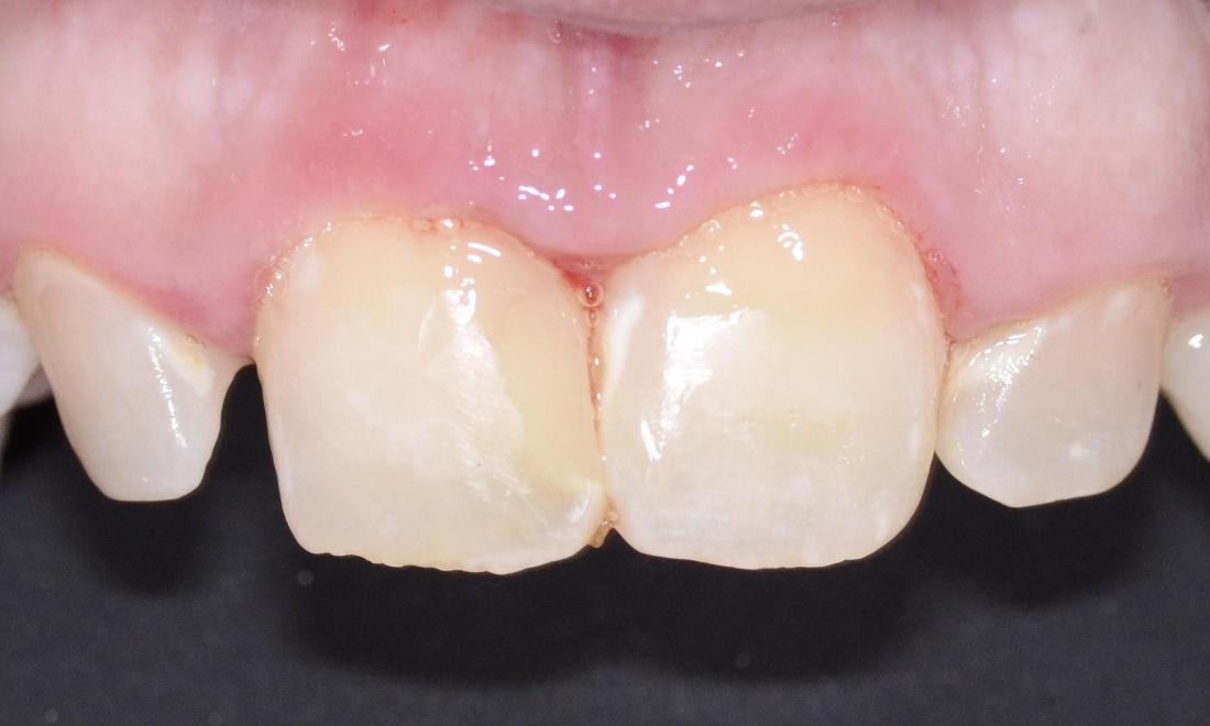 tooth colored fillings to fix chipped front teeth