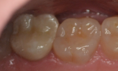 new tooth-colored filling