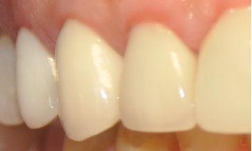 Metal Free Crowns | Alpharetta Creek Restorative Dentistry