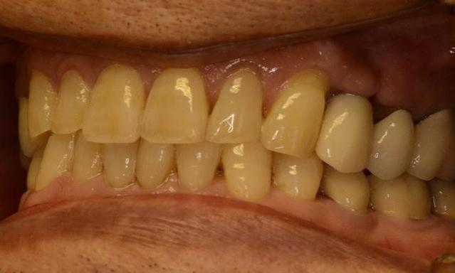 dental implant and crown used to replace missing tooth