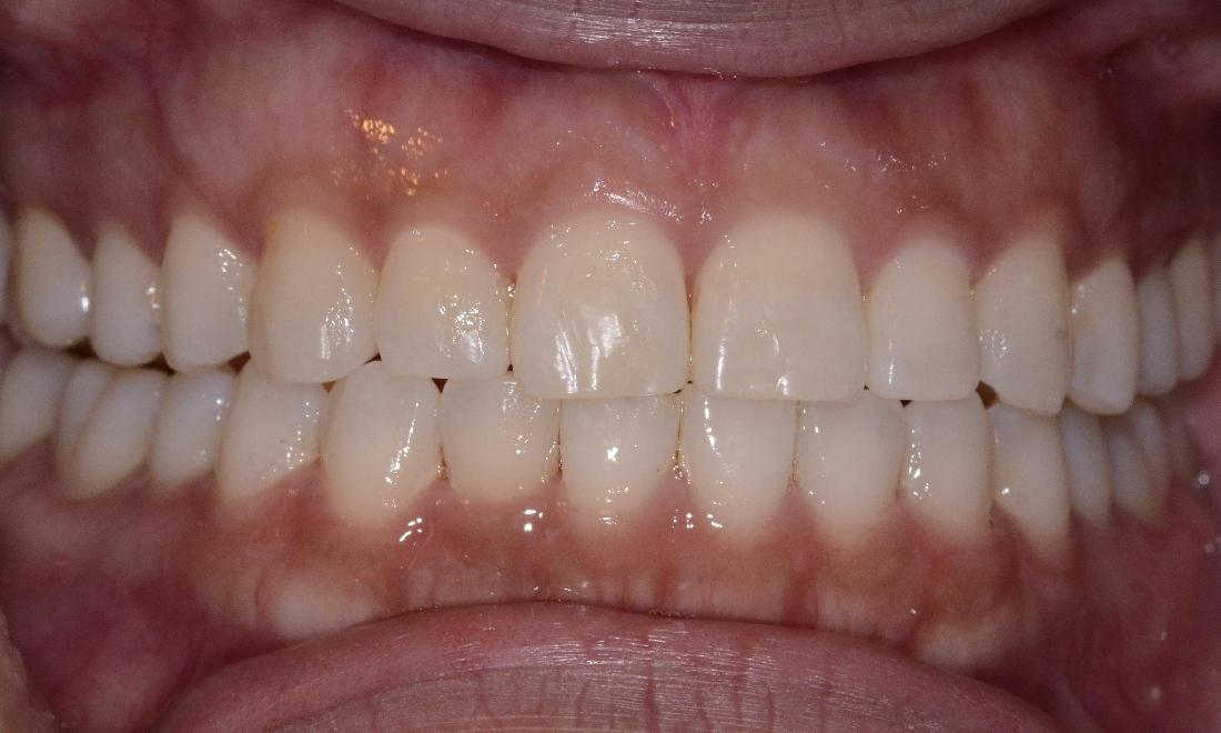 teeth after clear aligners