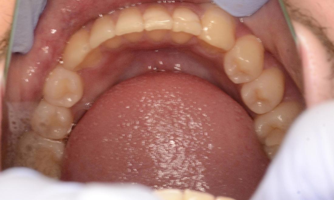 straightened front teeth