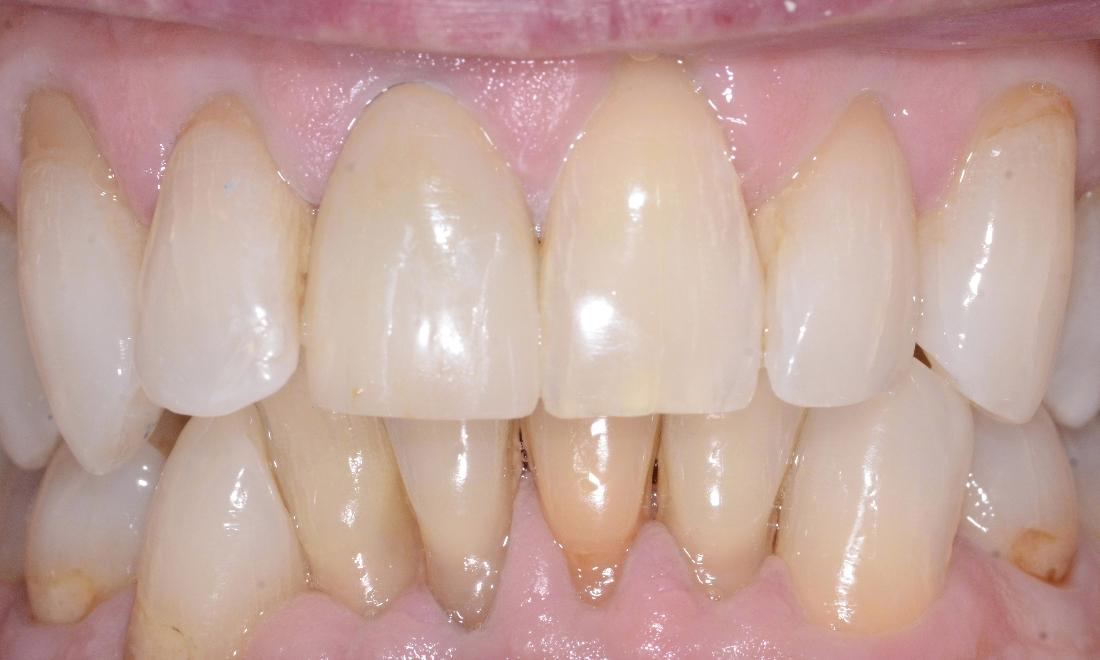 replaced missing crown of tooth