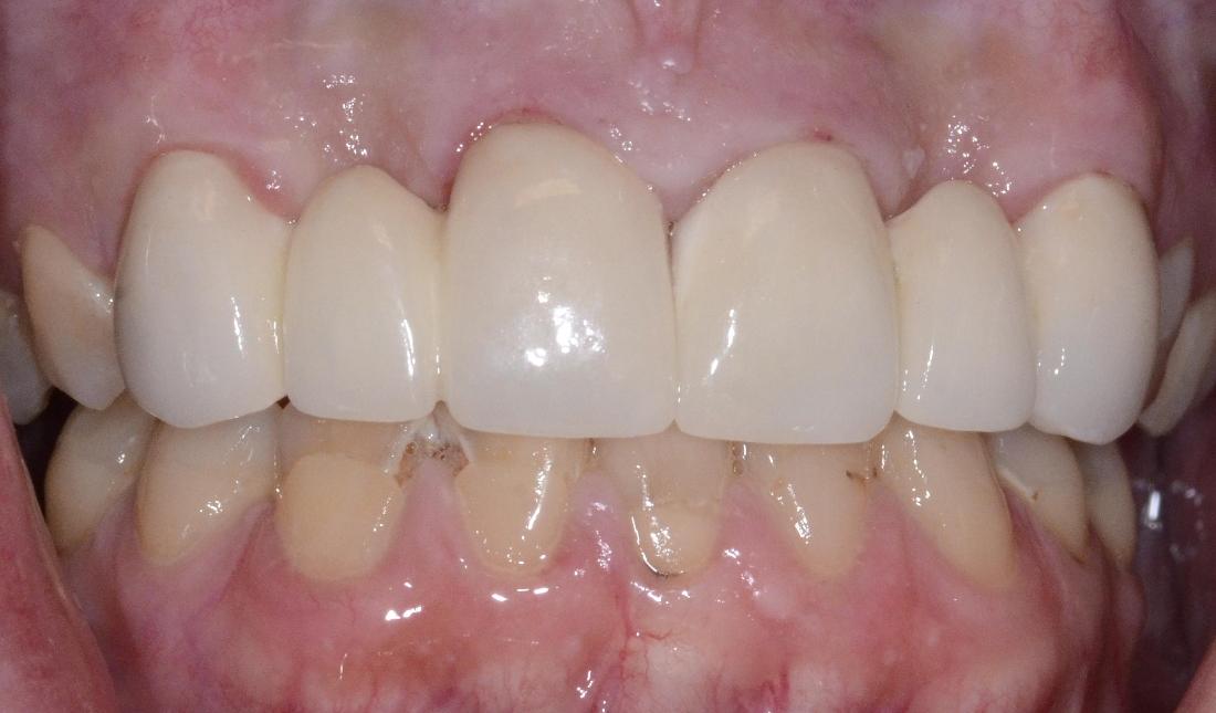 Missing front teeth replaced 