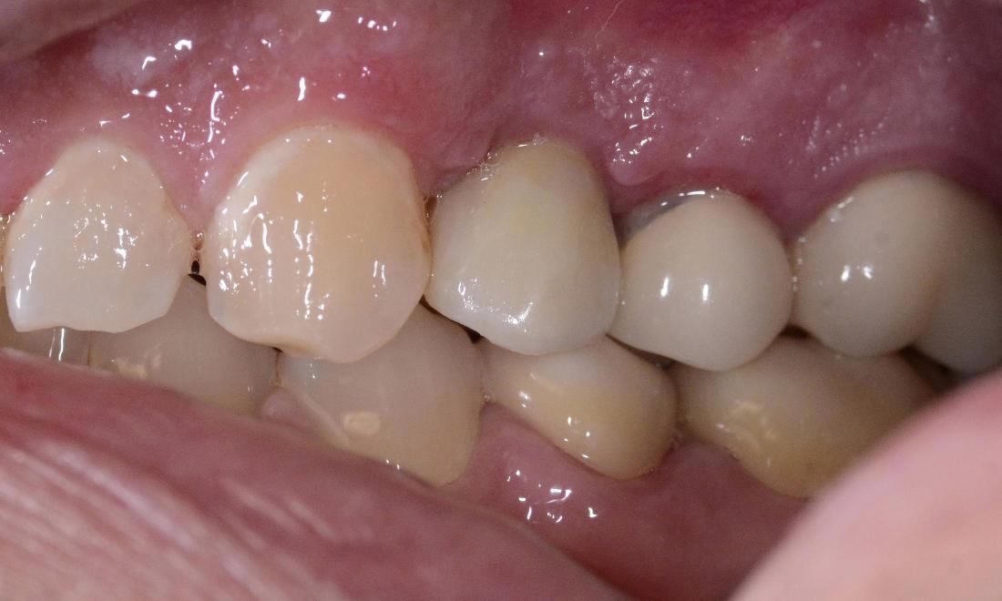 implant and crown used to replace missing tooth in smile zone