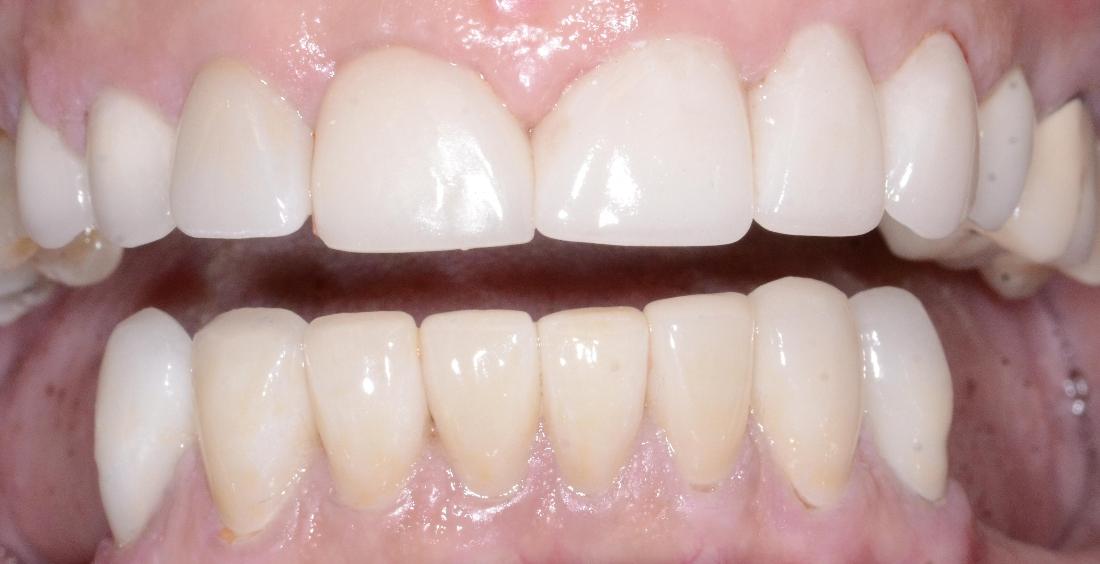 several crowns were replaced on lower teeth for a more uniform smile