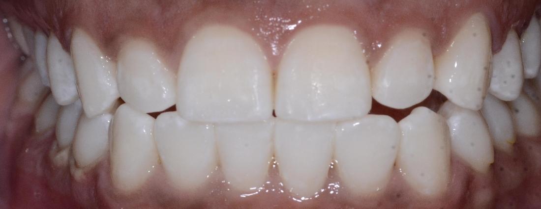bright white smile after professional teeth whitening