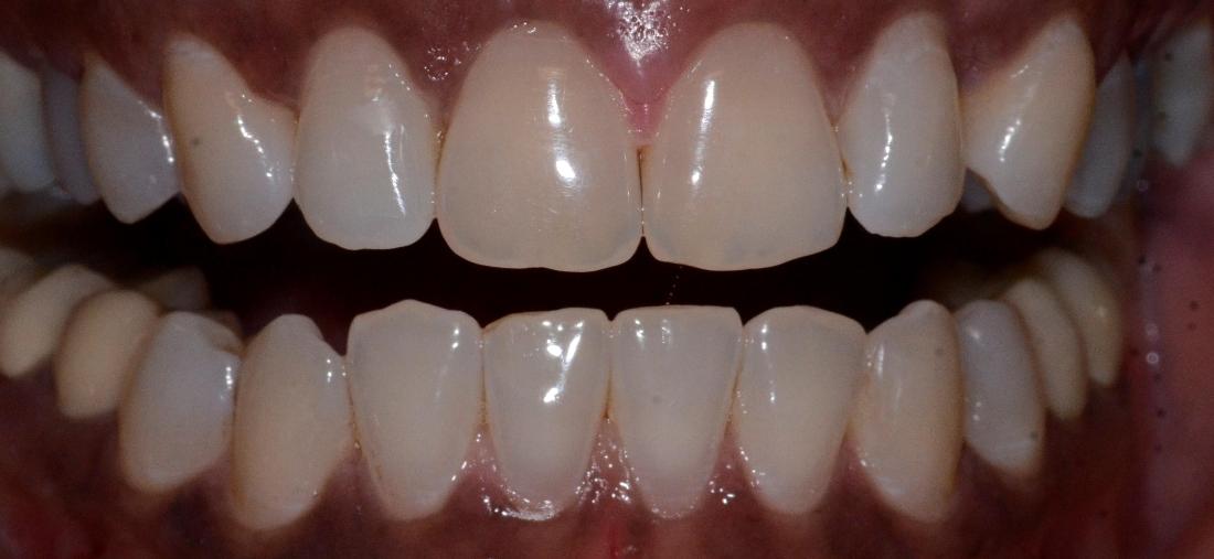 front teeth realigned and space fixed after clear aligners
