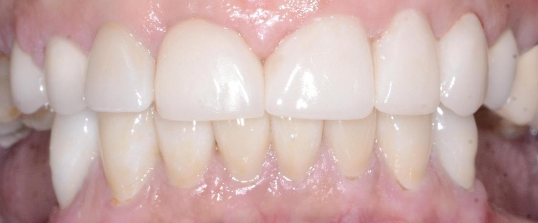 lower teeth more uniform after crowns