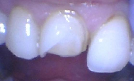 Broken Veneers | Alpharetta Creek Restorative Dentistry