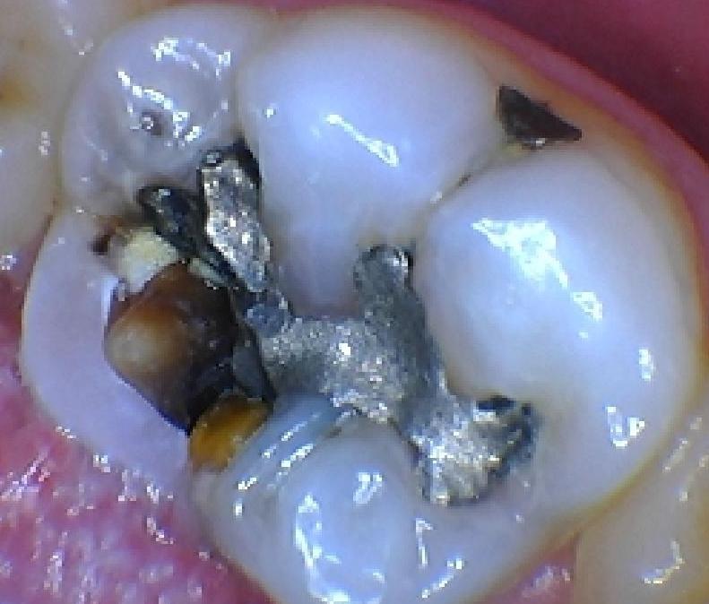 Broken Filling Replaced | Alpharetta Creek Restorative Dentistry