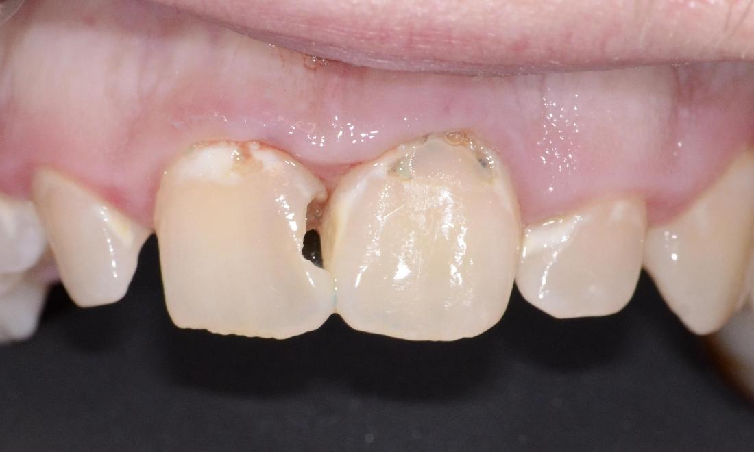 damaged and cracked front teeth