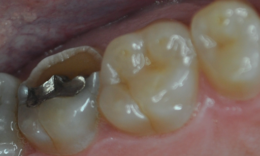 old silver filling