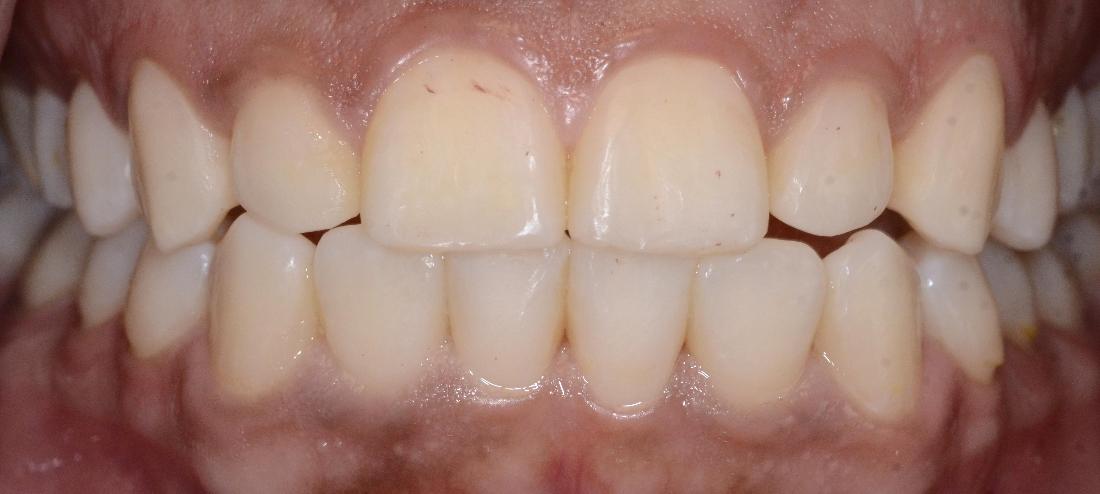 yellowed teeth before whitening