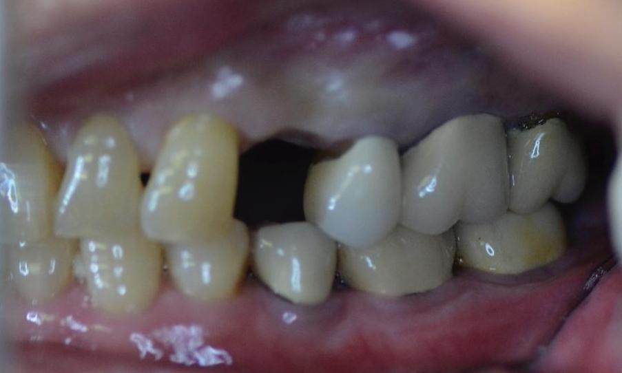 close up of patient's smile with missing tooth