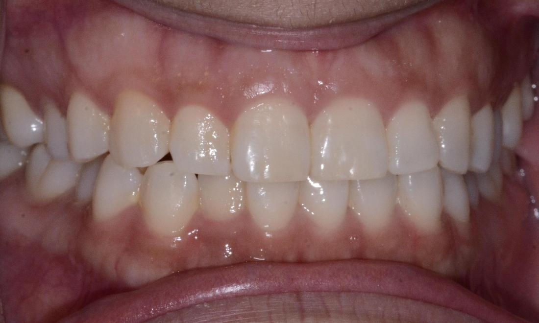 before clear aligners