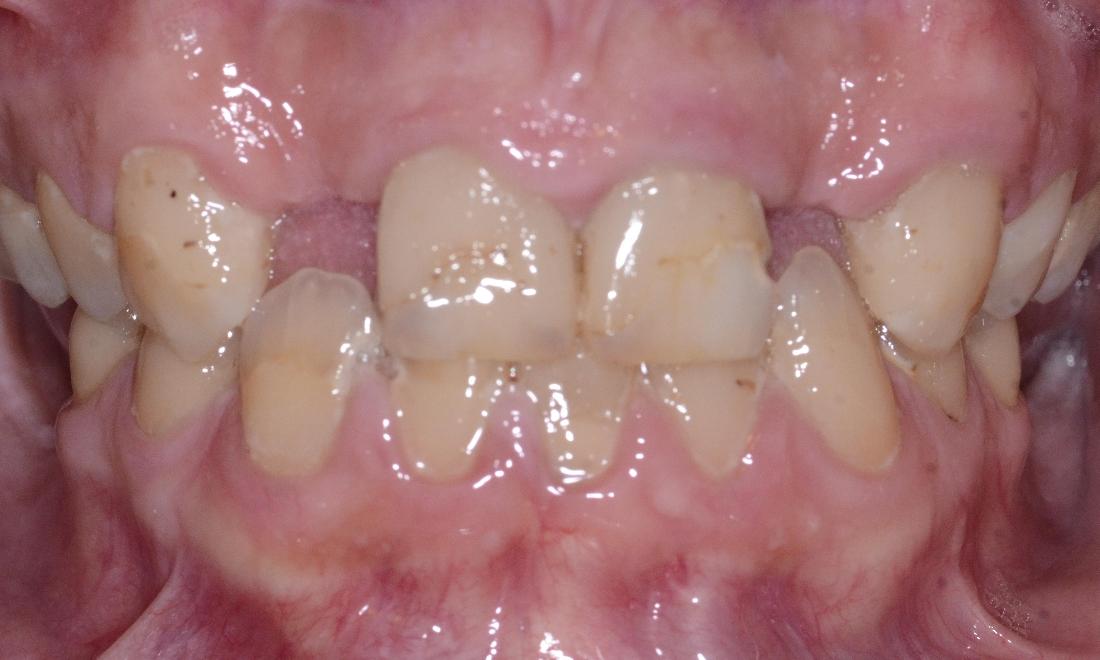 close up of patient missing front teeth
