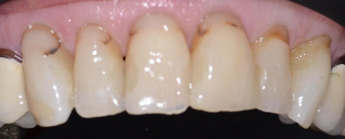 stained teeth and fillings along gum line