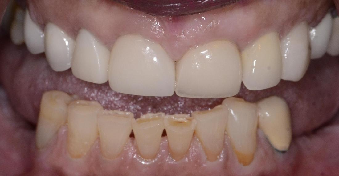 discolored and crooked lower teeth