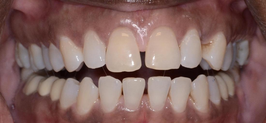 space between two front teeth and bottom teeth