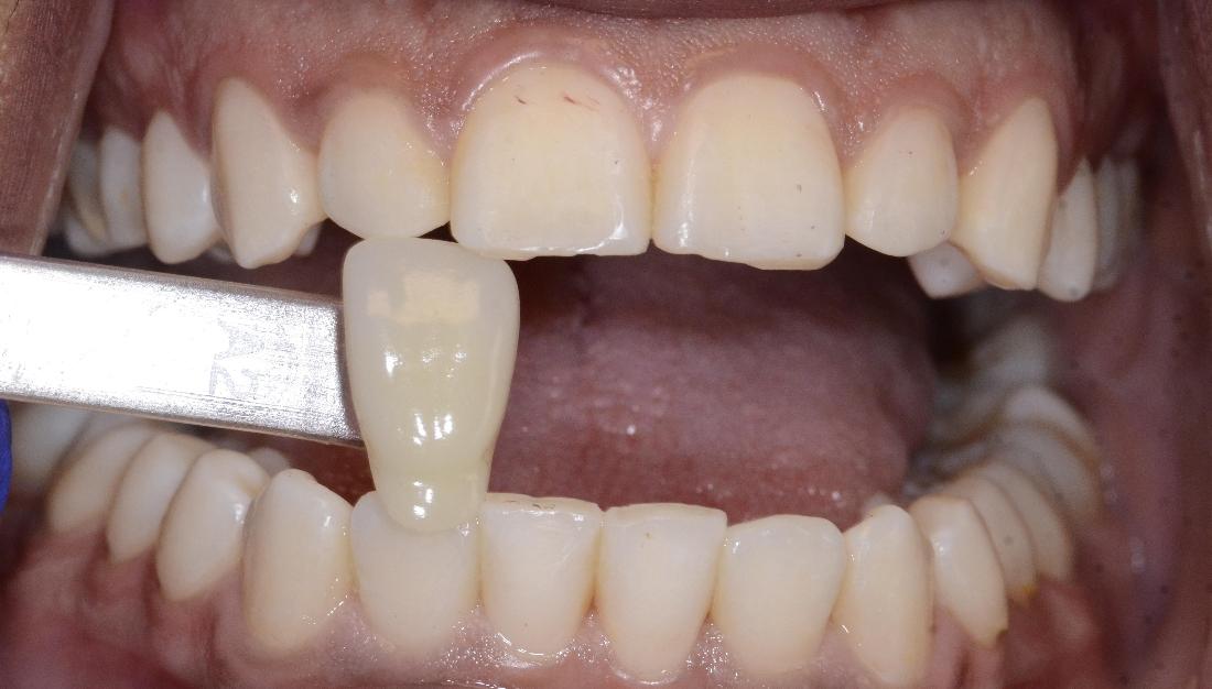 veneer used for pre-whitening comparison against smile