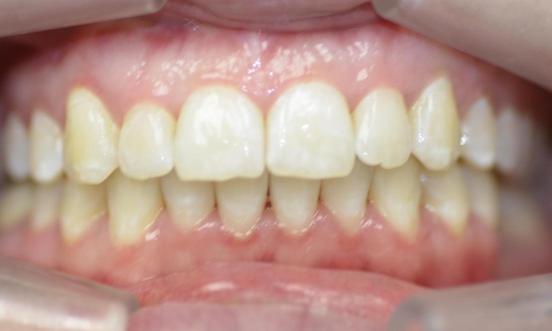 clear aligners fixed slight crowding and misaligned teeth
