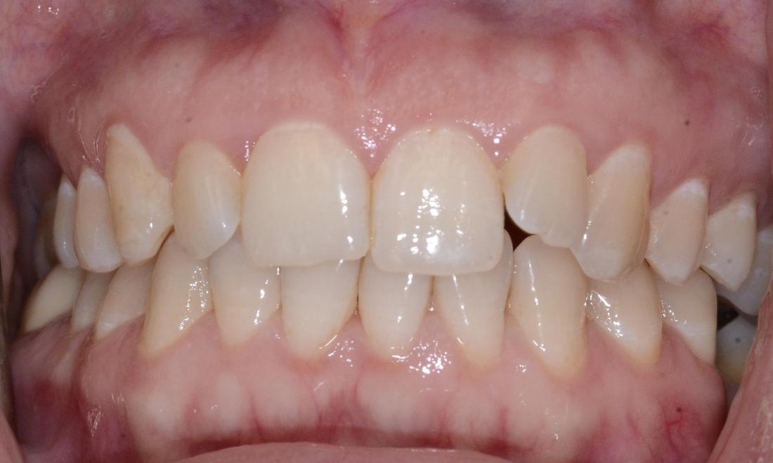 slight crowding of teeth