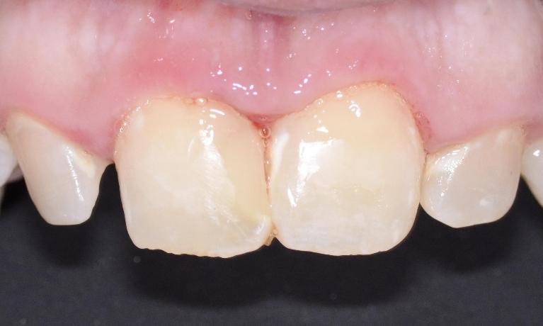 Smile Gallery | Before and After Case Photos | Dentist 30022