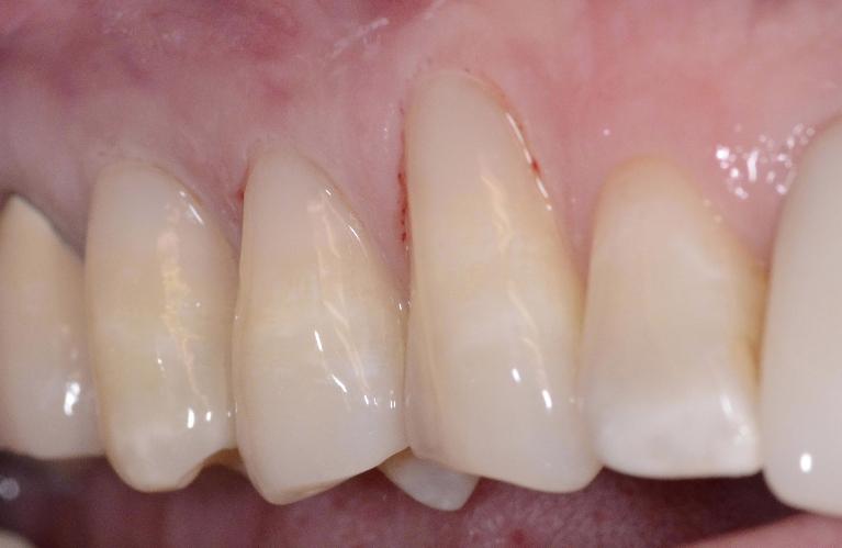 Repairing Gums | Alpharetta Creek Restorative Dentistry