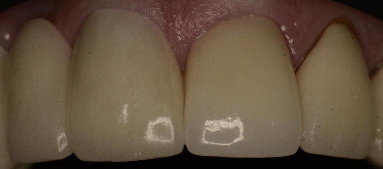 Fractured Crown | Alpharetta Creek Restorative Dentistry