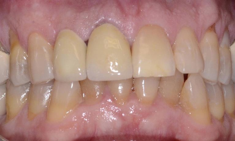 close up of patient's teeth after decay was treated