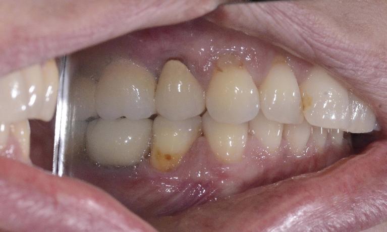 restore tooth after failed root canal