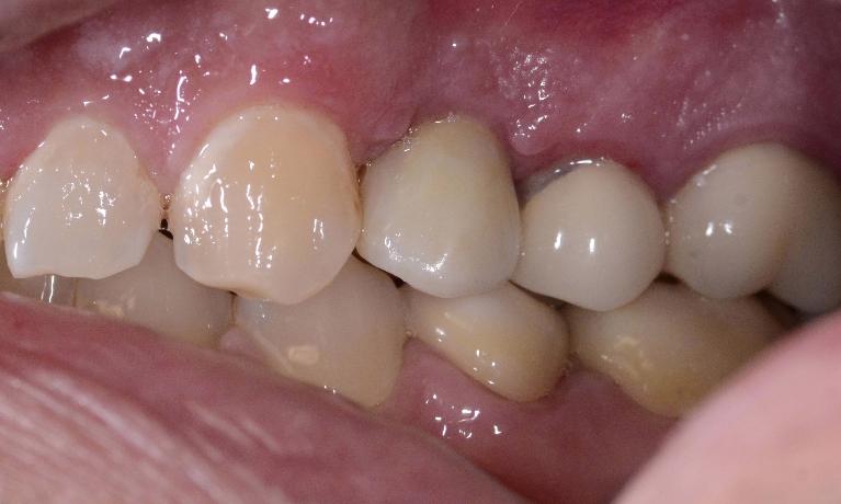 implant and crown used to replace missing tooth in smile zone