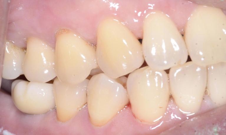 implant and crown used to fix a broken tooth