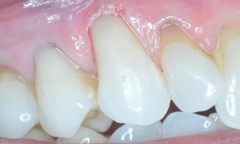 Tooth colored bonding used to cover exposed tooth roots