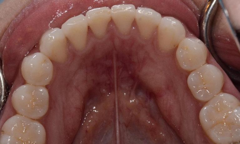 after using clear aligners