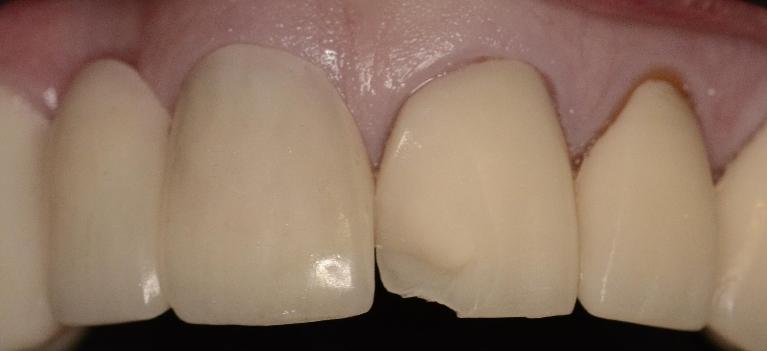 Fractured Crown | Alpharetta Creek Restorative Dentistry