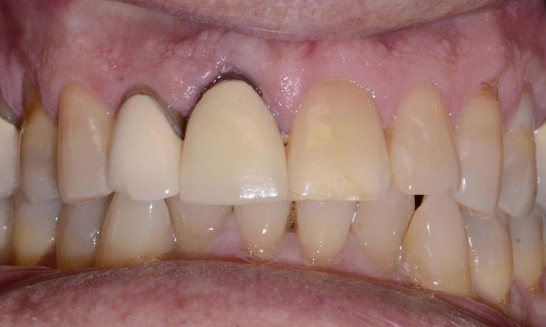 Decay under patient's dental crown