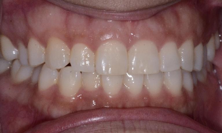 SureSmile-Clear-Aligners-Before-Image
