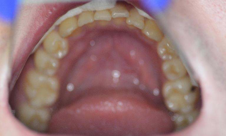 Minor-Crowding-Orthodontic-Relapse-Before-Image
