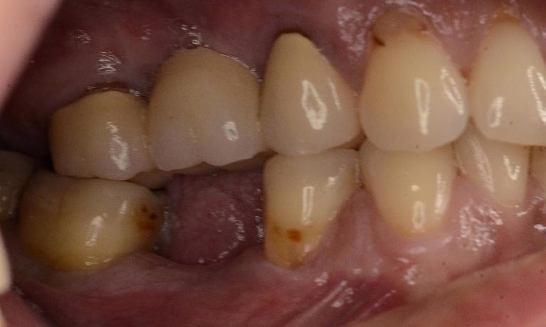 close up of site of failed root canal 